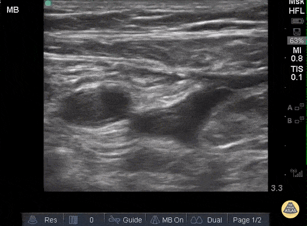 Vascular - DVT - Common Femoral