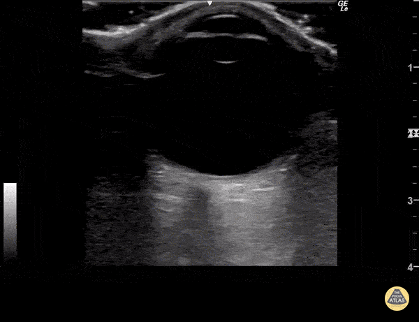 Orbital - Looking Around - Normal Exam