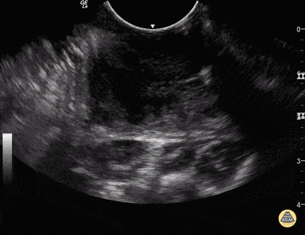 Soft Tissue - Peritonsillar Abscess