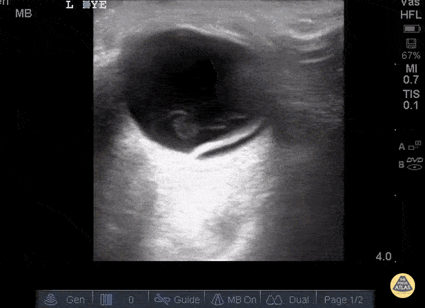 Orbital - Retinal Detachment