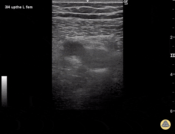 Vascular - DVT - Superficial Femoral Vein