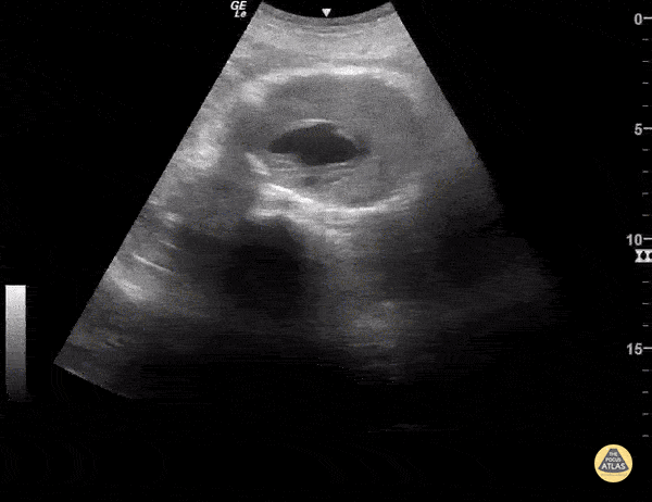 Aorta - Abdominal Aortic Aneurysm