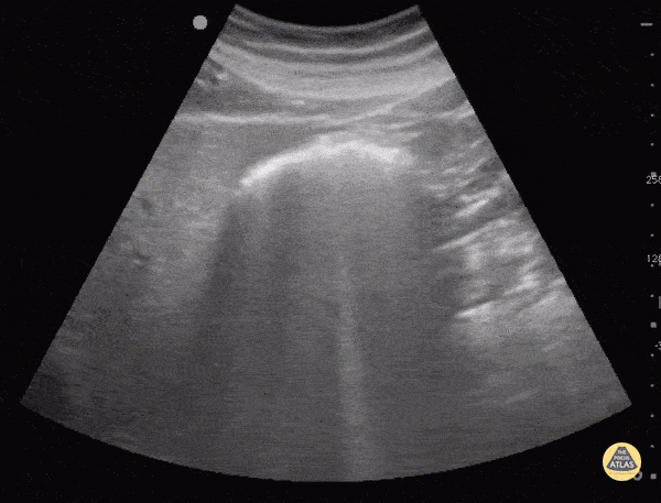 Bowel-GI - Bowel Gas