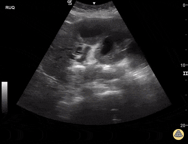 Bowel-GI - Cholangiocarcinoma with Metastases