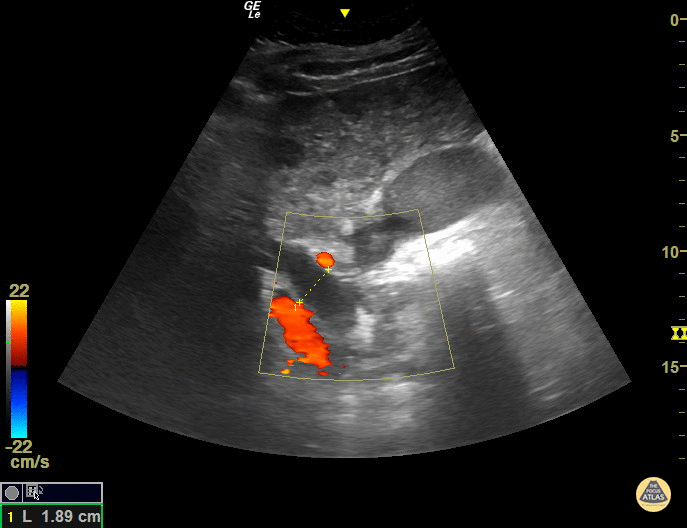 Biliary - Dilated Common Bile Duct