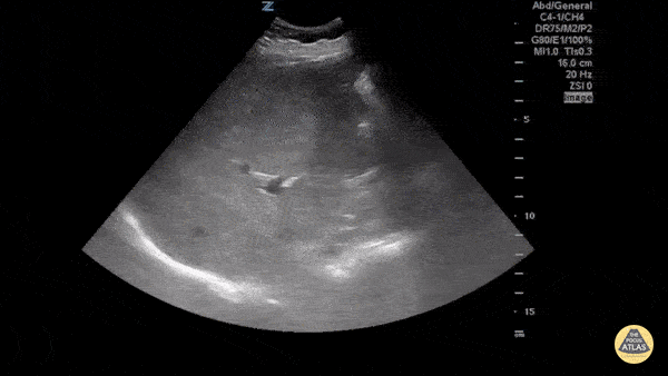 Biliary - Cholecystitis - Emphysematous