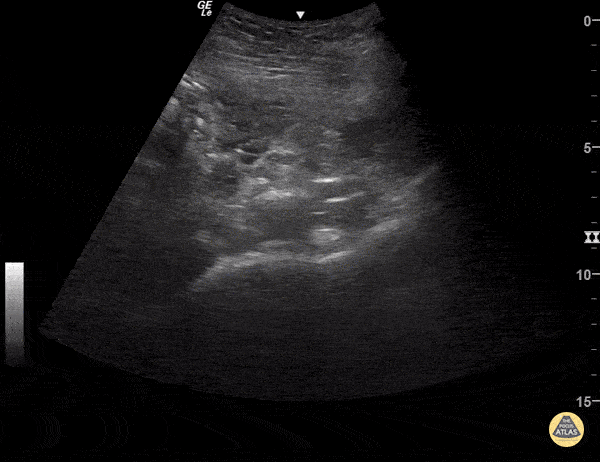OB/Gyn - Hemorrhagic Cyst and Subchorionic Hemorrhage