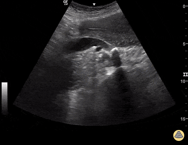 Renal/GU - Hydroureter with Stone