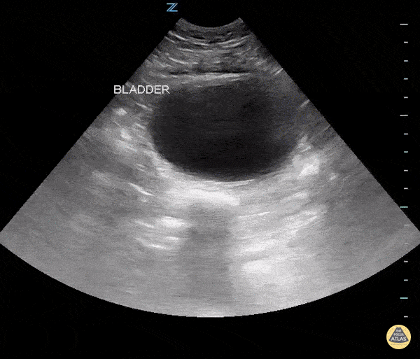Renal/GU - Large Prostate