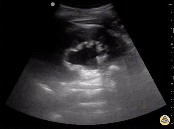 Renal/GU - Moderate Hydronephrosis