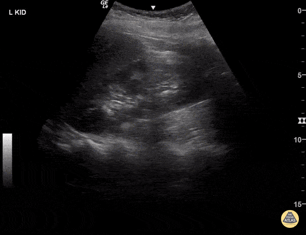 Renal/GU - Normal Kidney