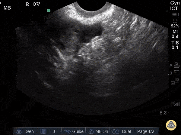 OB/Gyn - Normal Ovaries