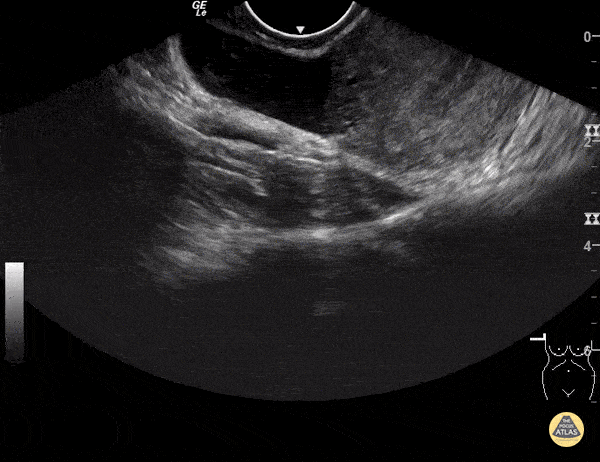 OB/Gyn - Ovarian Cyst
