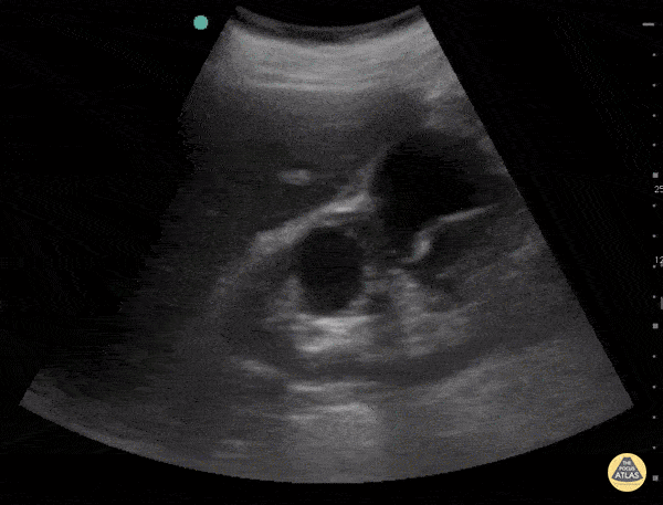 Renal/GU - Renal Cysts