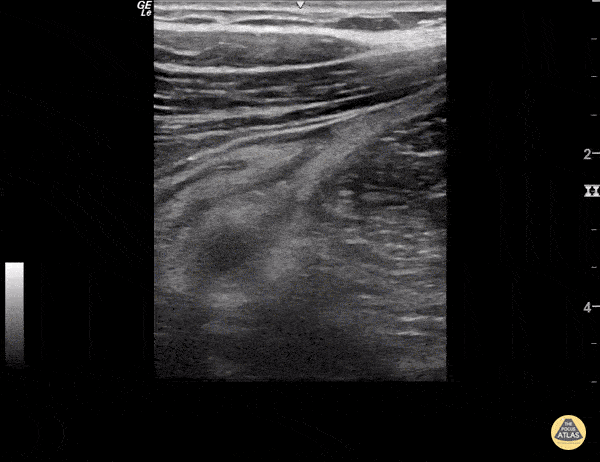 Bowel-GI - Retrocecal Appendicitis