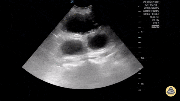 Bowel-GI - Small Bowel Obstruction