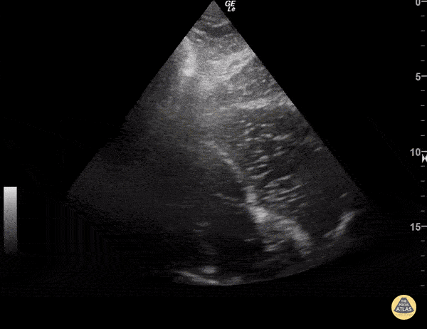 Left Ventricular Dysfunction - Asystole