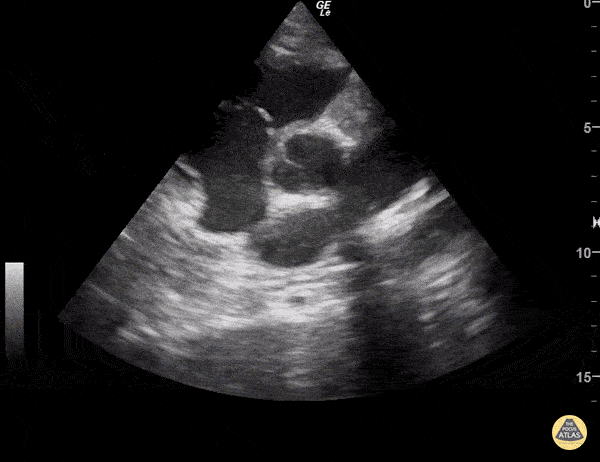 Valvulopathy - Pulmonic Vegetation