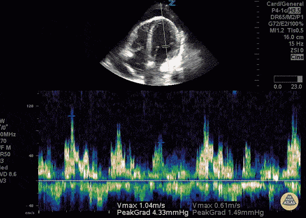 Pericardial Disease - Cardiac Tamponade with Doppler