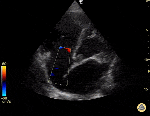 Right Ventricular Dysfunction - Right Ventricular Failure with Tricuspid Regurgitation