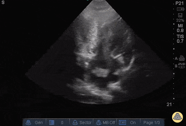 Other Cardiac Pathology - A Fib with Left Atrial Thrombus