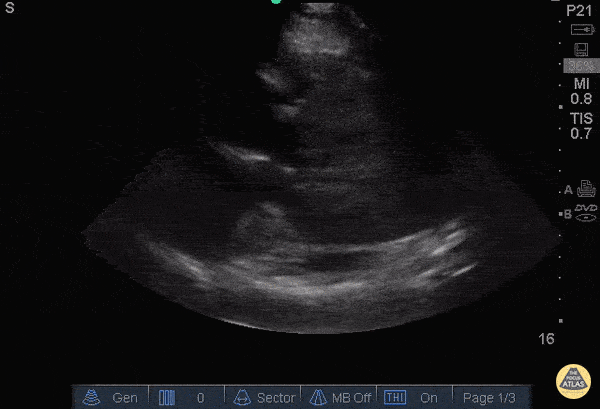 Other Cardiac Pathology - A Fib with Left Atrial Thrombus (parasternal long)