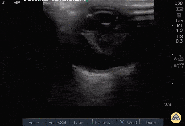 Orbital - Retinal Detachment with Vitreous Hemorrhage