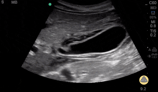 Biliary - Pericholecystic Fluid - Long