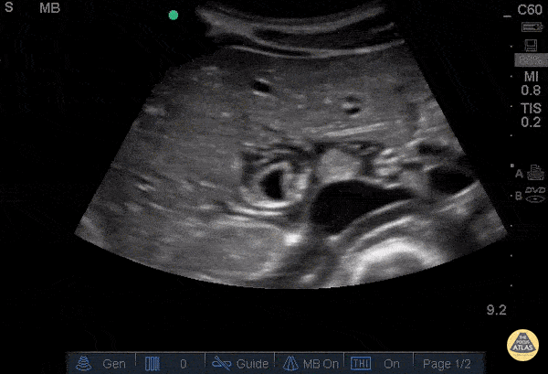 Biliary - Pericholecystic Fluid - Transverse