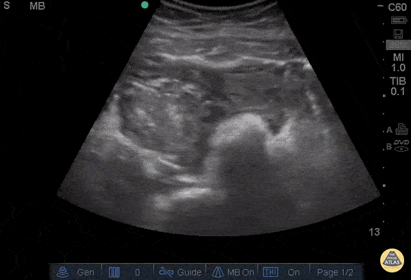 OB/Gyn - Ruptured Ovarian Cyst - Hematoma