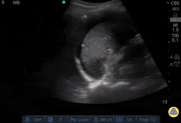 OB/Gyn - Positive FAST in LUQ - Ruptured Ovarian Cyst