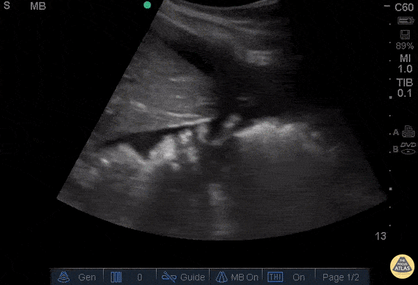 OB/Gyn - Positive FAST in RUQ - Ruptured Ovarian Cyst