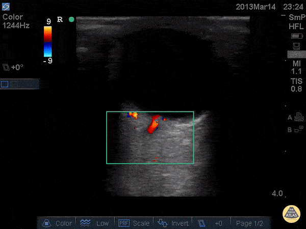 Orbital - Central Retinal Artery and Venous Flow - Normal