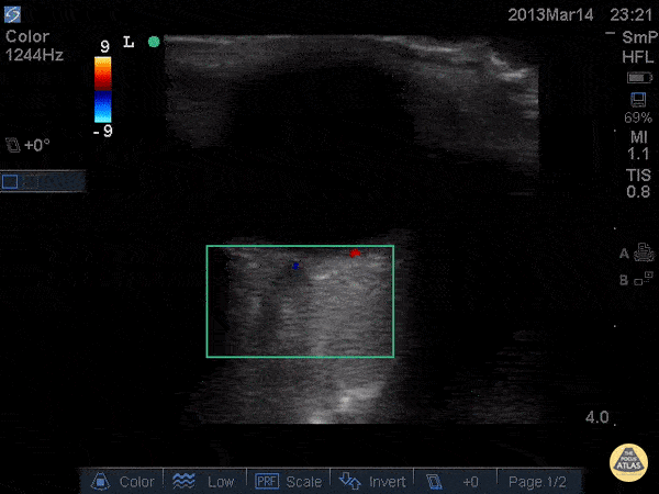 Orbital - Central Retinal Artery Occlusion