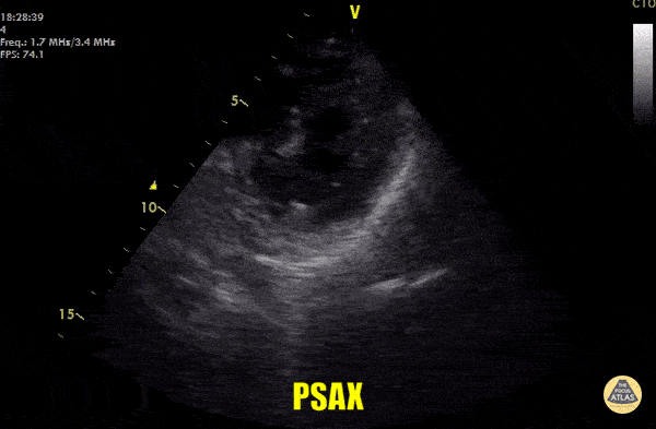 Left Ventricular Dysfunction - Asystole