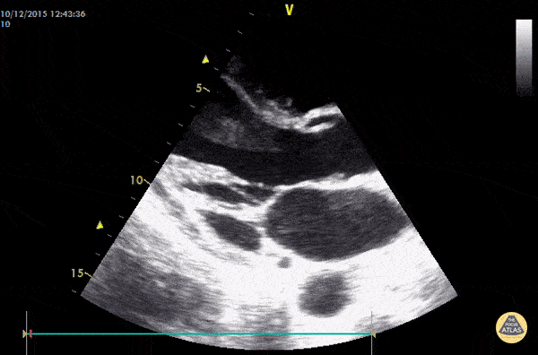 Valvulopathy - Endocarditis