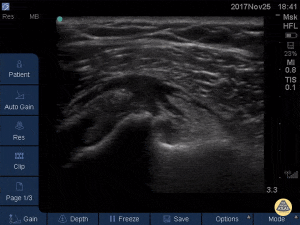 Musculoskeletal - Subscapularis Tendinopathy