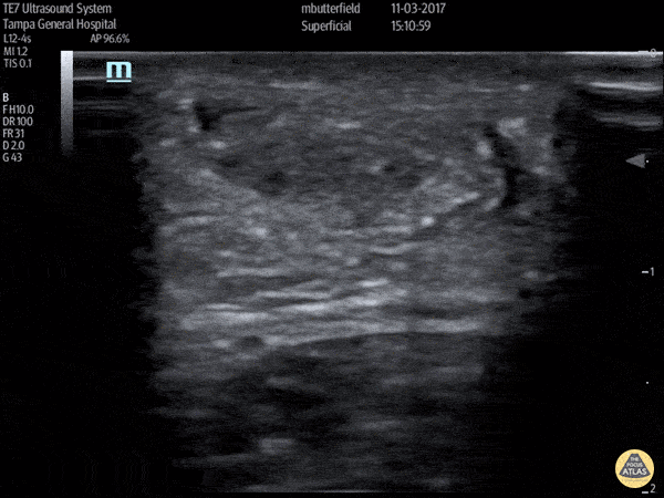 Musculoskeletal - Achilles Tendon Rupture (Short Axis)