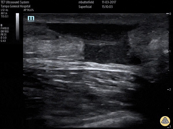 Musculoskeletal - Achilles Rupture (Long Axis)