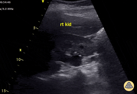 Renal/GU - Hydroureter with Moderate Hydronephrosis