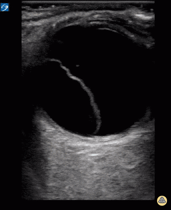 Orbital - Retinal Detachment
