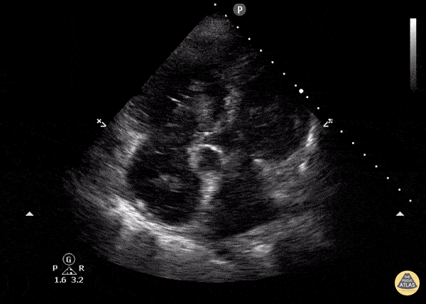 Right Ventricular Dysfunction - Right Atrial Thrombus