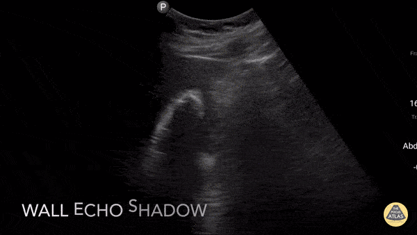 Biliary - Wall Echo Shadow