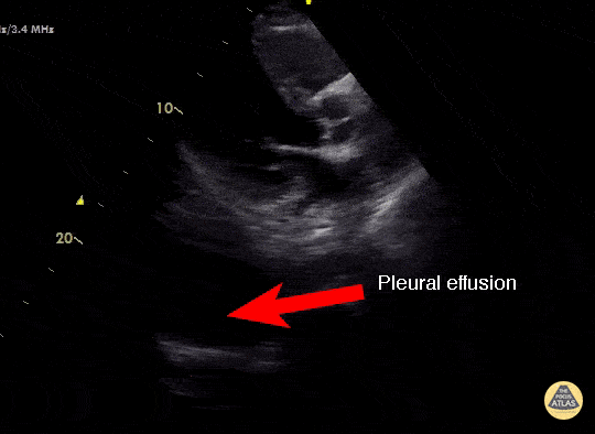 Pulmonary - Concealed Pleural Effusion