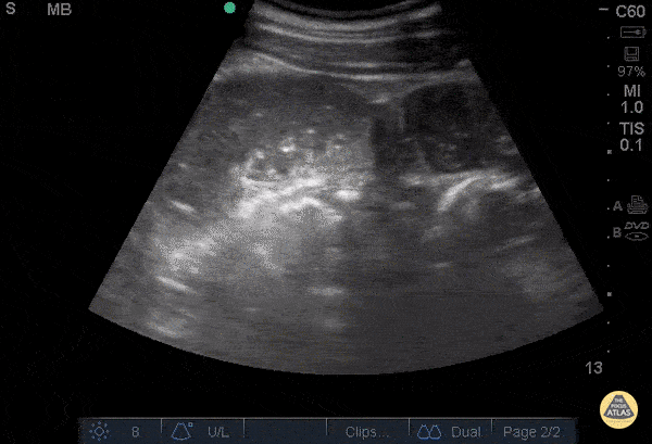 Bowel-GI - Small Bowel Obstruction