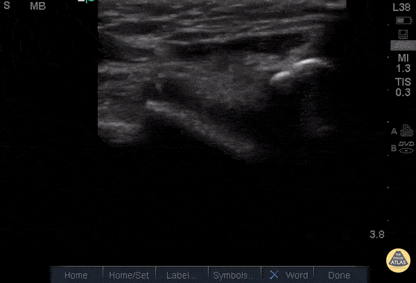 Musculoskeletal - Quad Tendon Rupture (Bilateral)
