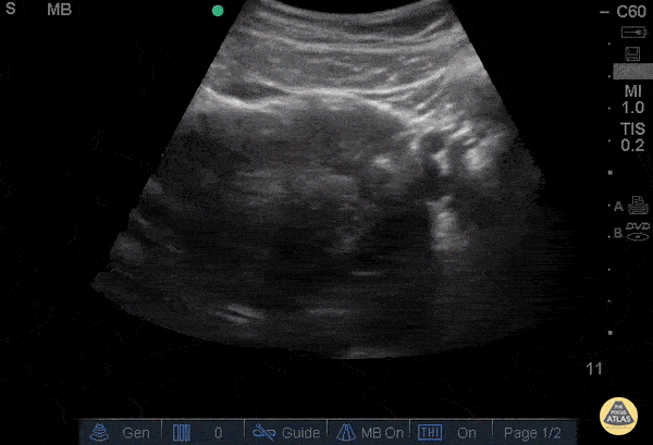 OB/Gyn - Ectopic - Ruptured Cornual Ectopic Pregnancy