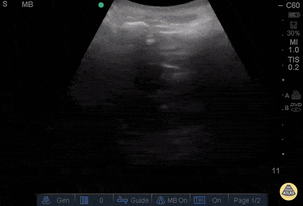 OB/Gyn - Anembryonic Pregnancy