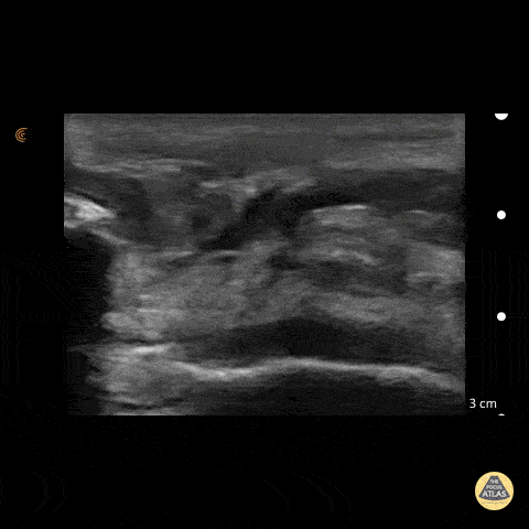 Musculoskeletal - Patellar Tendon Rupture