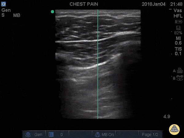 Pulmonary - Lung Point: Pneumothorax